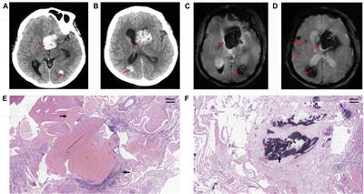 A Novel CCM2 Missense Variant Caused Cerebral Cavernous Malformations in a Chinese Family